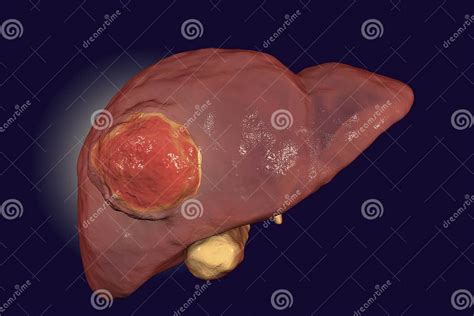 Liver Cancer Illustration Stock Illustration Illustration Of Medical 95090767