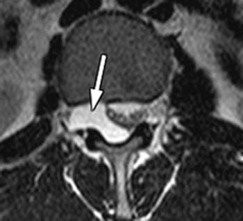 Lumbar Synovial Cyst Radsource