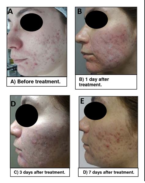 Figure 2 From Photodynamic Therapy With 5 Aminolevulinic Acid Ala In The Treatment Of Acne