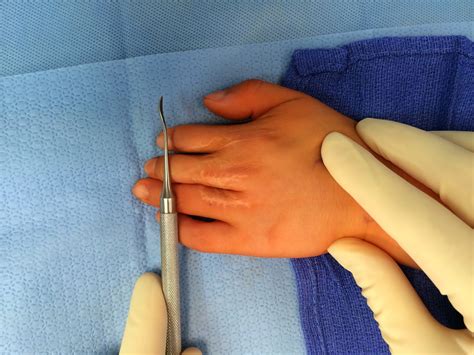 Scarring after Syndactyly | Congenital Hand and Arm Differences | Washington University in St. Louis