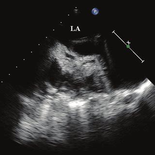 Transesophageal Echocardiographic Examination Showing A Large Left