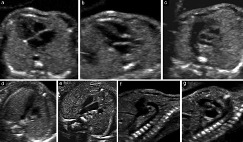 Fetal Cardiac Ultrasound