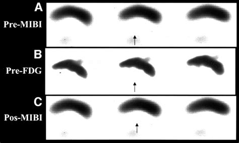 M Tc Mibi Spect A And Fdg Pet B Images Of Patient With Mi Show