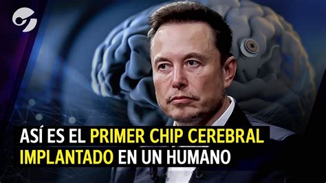 Cómo Funciona Telepathy El Chip Cerebral Que Una Empresa De Elon Musk Implantó En Un Humano