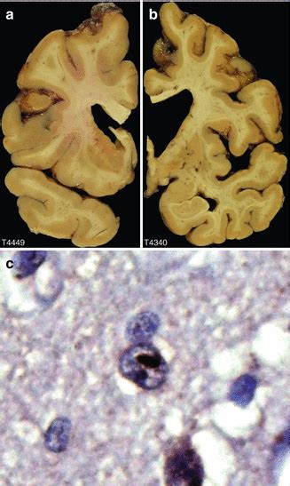 Huntingtons Disease Neupsy Key