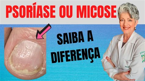 Psoríase Ungueal vs Micose Entenda as Diferenças