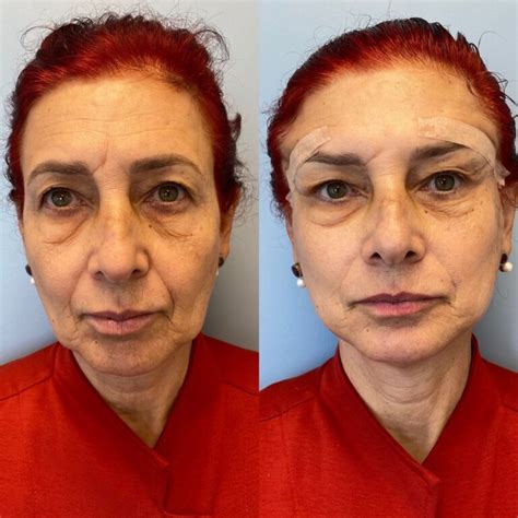 Lifting Facial Fios Dra Paula Gomes Medicina Est Tica