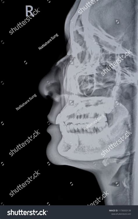 Nasal Bone X Ray Anatomy