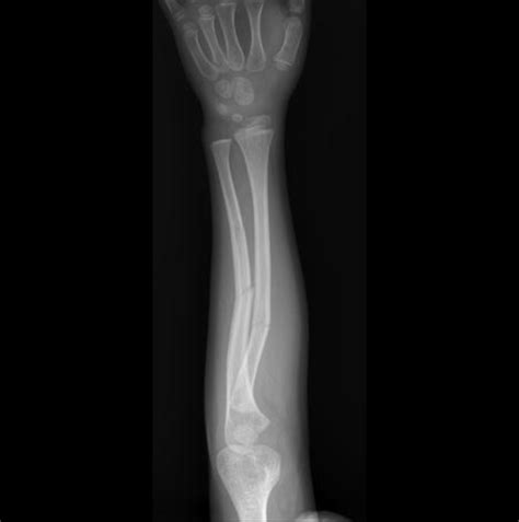 Greenstick Fracture Arm