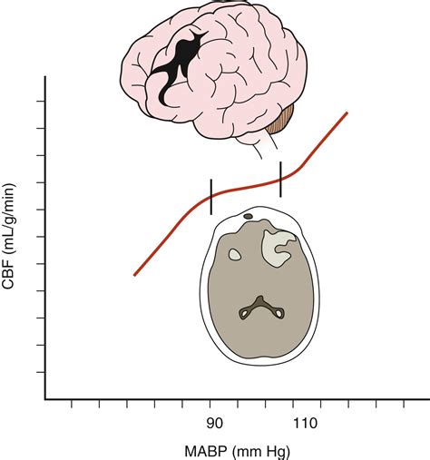 Perioperative Management Of Severe Traumatic Brain Injury In Adults