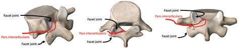 Pars Interarticularis Defect Injury • Peak Physio