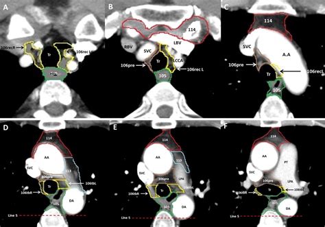 Atlas Of The Thoracic Lymph Nodal Delineation And Recommendations For