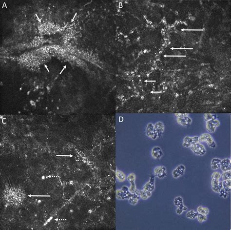 Acanthamoeba Keratitis Confocal