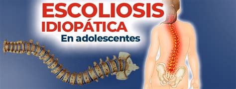 Que Es La Escoliosis En Adolescentes Cordus M Xico