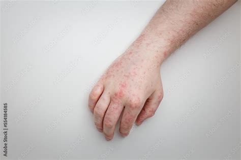 Patient Shows Arm And Hand With Red Itchy Painful Rash Allergic Symptom On Male Hands