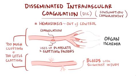 Disseminated Intravascular Coagulation Clotting Cascade