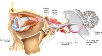 Posttraumatic Bilateral Abducens Nerve Palsy: Mechanism of Injury and ...