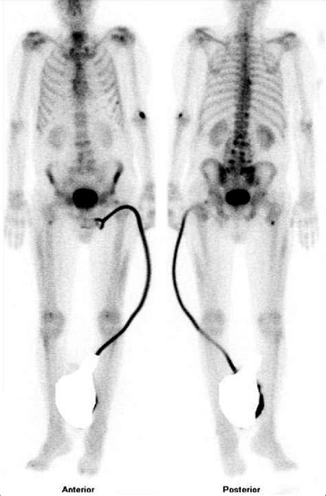 Bone Scan With Tc M Mdp Methylene Diphosphonate Revealed Multiple