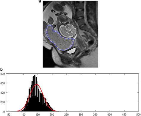 A 26 Year Old Woman With A Normal Placenta A Sagittal T2 Mr Image Download Scientific Diagram