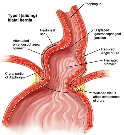 Hiatus Hernia: Symptoms, Diagnosis, Treatment & Complications – Health and Recipes