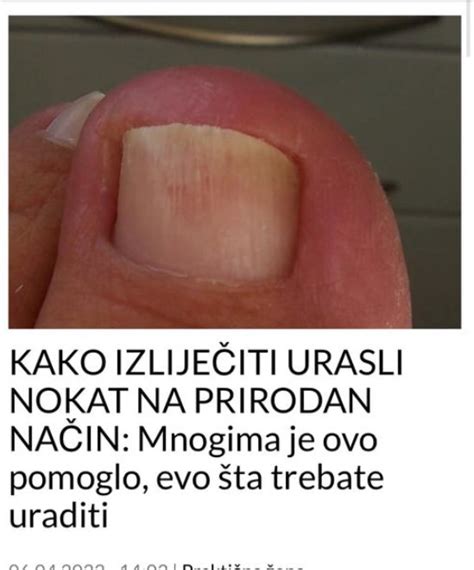 Kako Izlije Iti Urasli Nokat Na Prirodan Na In Mnogima Je Ovo Pomoglo