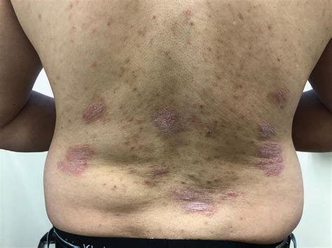 Photos Psoriasis