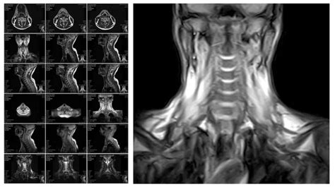 Magnetic Resonance Imaging Of The Cervical Spine Stock Photo By