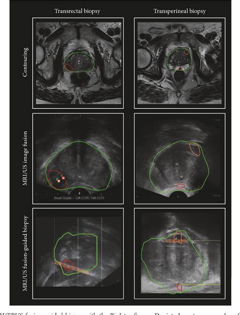 Figure 1 From Evaluation Of Mriultrasound Fusion Guided Prostate Biopsy Using Transrectal And