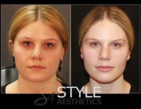 Cheek Enhancement Augmentation Voluma Ha Fillers Natural Before Lyft