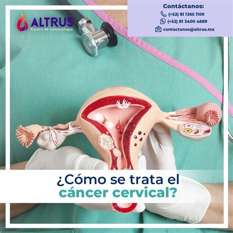 Tratamiento C Ncer Cervical Altrus Cancerolog A