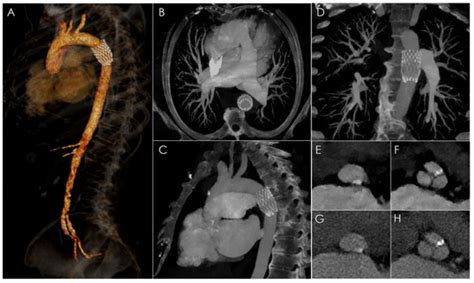 Spectral Ct Imaging Of Prosthetic Valve Embolization After