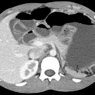 Ultrasound image in the epigastrium showing two rounded solid nodular ...