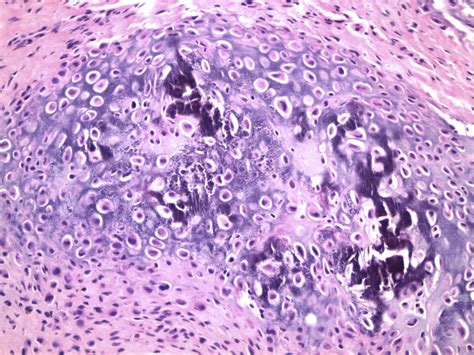 chondroblastoma   temporomandibular joint report   case