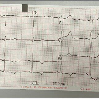 ECG showed ischemia at inferior and lateral leads. | Download Scientific Diagram