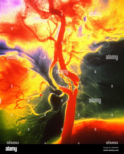 La Estenosis De La Arteria Renal El Angiograma Color Rayos X De