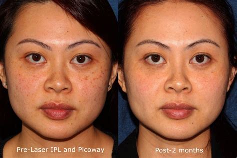 Lumenis M22 Ipl Laser Resurfacing San Diego Ca Clderm