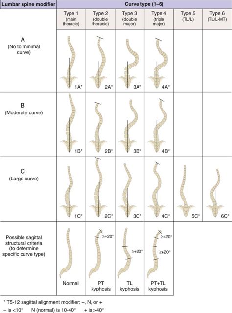 Scoliosis Musculoskeletal Key