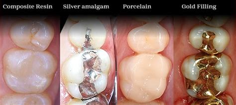 Types Of Dental Tooth Filling In Dubai UAE BEST Orthodontist