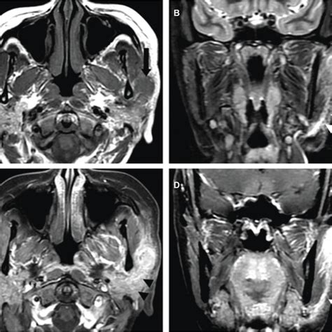 Tuberculosis Of The Left Parotid Lymph Node In A 19 Year Old Male