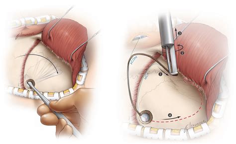 Cavernous Malformation Surgery Aaron Cohen Gadol Md