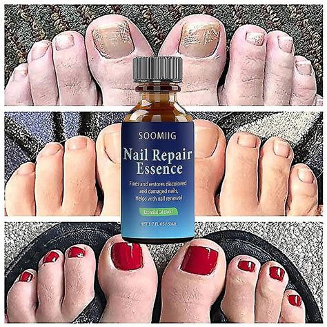 Nail Repair Serum Nail Fungal Treatment Serum Onychomycosis Paronychia