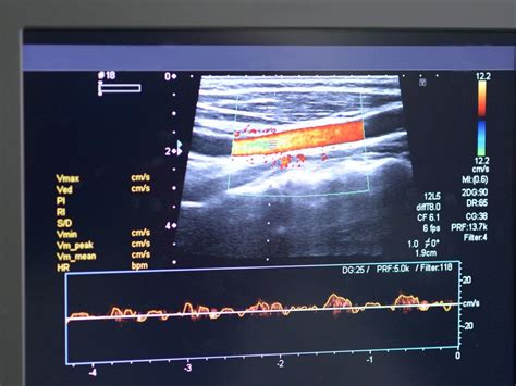 Diagnosis Atherosclerosis