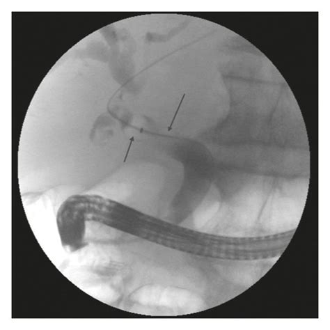 Ercp Images Demonstrate Multiple Filling Defects Green Arrows Within Download Scientific