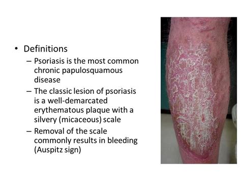 Psoriasis And Other Papulosquamous Disease Definitions Psoriasis Is