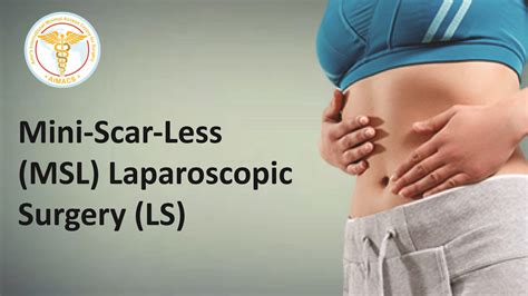 Recovery After Laparoscopic Nissens Fundoplication What To Expect