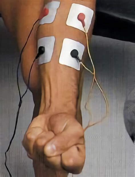 Guía Para La Colocación De Electrodos En Fisioterapia