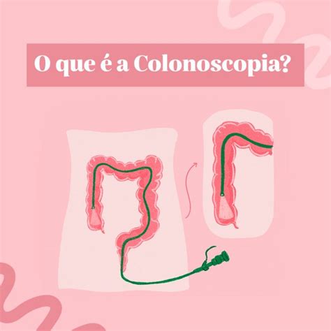 O Que E Colonoscopia - O que é a colonoscopia? - Dra. Aline Celeghini Coloproctologista