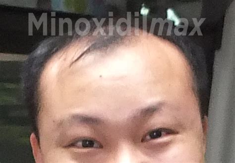 Minoxidil Results Before After Amazing Pictures