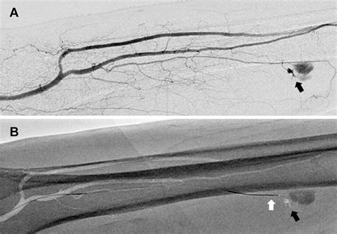 下肢血管腔内治疗方面最大限度地运用Trinias的应用程序 用户体验 Minimally Invasive Experience 岛津医疗