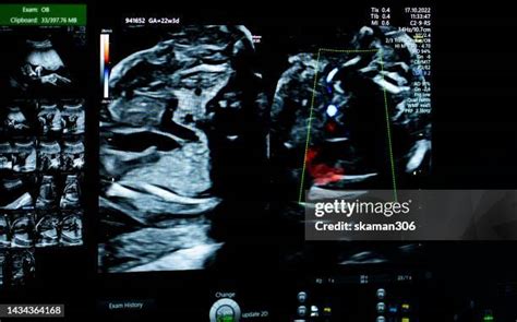 57 22 Weeks Pregnant Ultrasound Stock Photos, High-Res Pictures, and Images - Getty Images